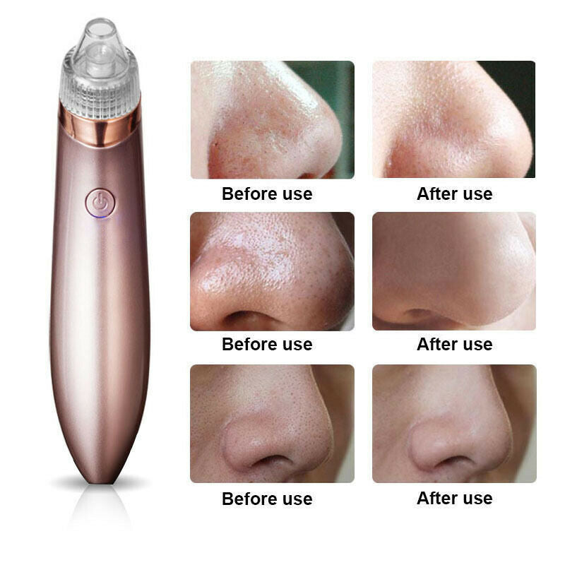 Electric Blackhead Vacuum Pore Cleaner Acne Pimple